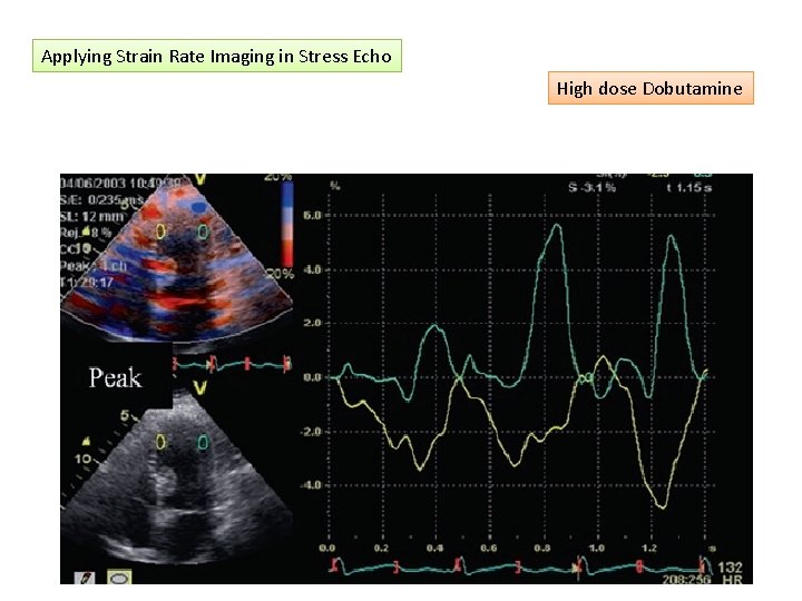 Applying Strain Rate Imaging in Stress Echo High dose Dobutamine 