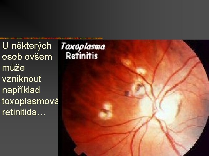 U některých osob ovšem může vzniknout například toxoplasmová retinitida… 