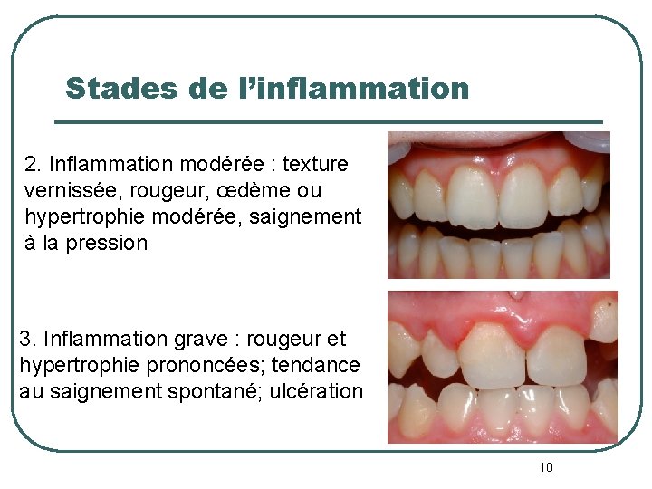 Stades de l’inflammation 2. Inflammation modérée : texture vernissée, rougeur, œdème ou hypertrophie modérée,