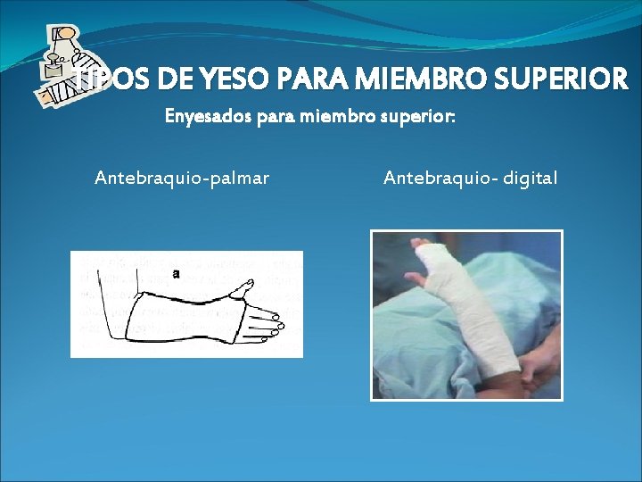 TIPOS DE YESO PARA MIEMBRO SUPERIOR Enyesados para miembro superior: Antebraquio-palmar Antebraquio- digital 