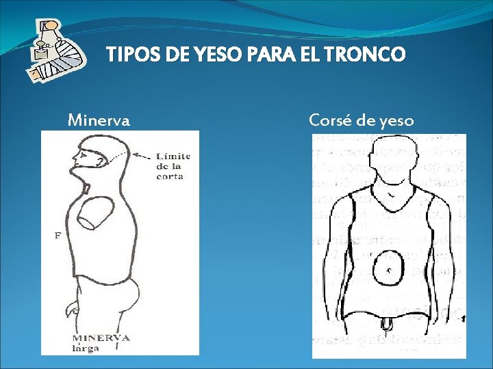 TIPOS DE YESO PARA EL TRONCO Minerva Corsé de yeso 