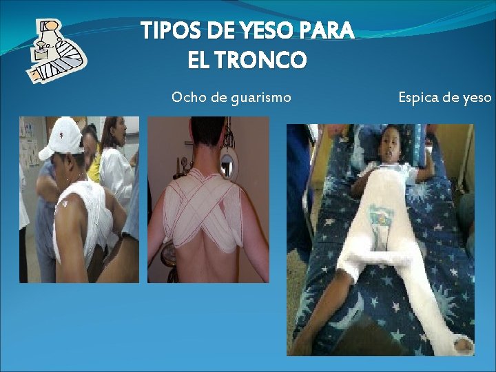 TIPOS DE YESO PARA EL TRONCO Ocho de guarismo Espica de yeso 