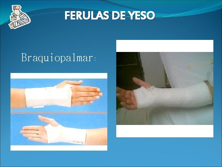 FERULAS DE YESO Braquiopalmar: TIPOS DE FERULA: BRAQUIO PALMAR 