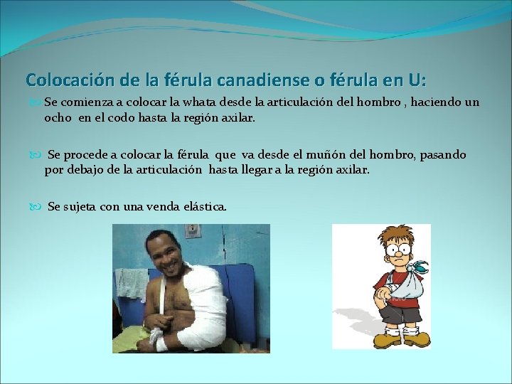 Colocación de la férula canadiense o férula en U: Se comienza a colocar la