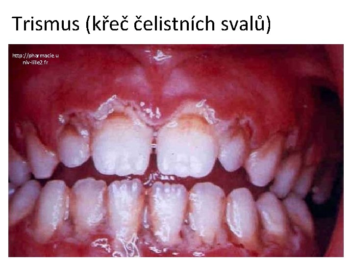 Trismus (křeč čelistních svalů) http: //pharmacie. u niv-lille 2. fr 