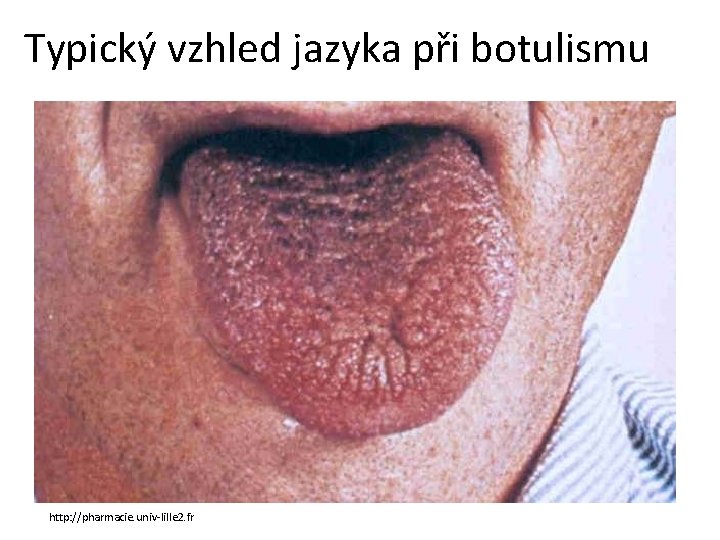 Typický vzhled jazyka při botulismu http: //pharmacie. univ-lille 2. fr 