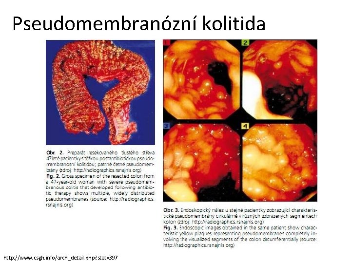 Pseudomembranózní kolitida http: //www. csgh. info/arch_detail. php? stat=397 