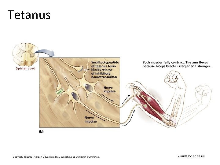 Tetanus www 2. bc. ca. us 