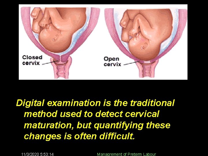 Digital examination is the traditional method used to detect cervical maturation, but quantifying these