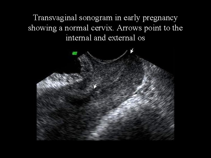 Transvaginal sonogram in early pregnancy showing a normal cervix. Arrows point to the internal