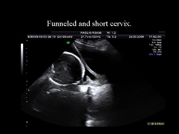 Funneled and short cervix. 