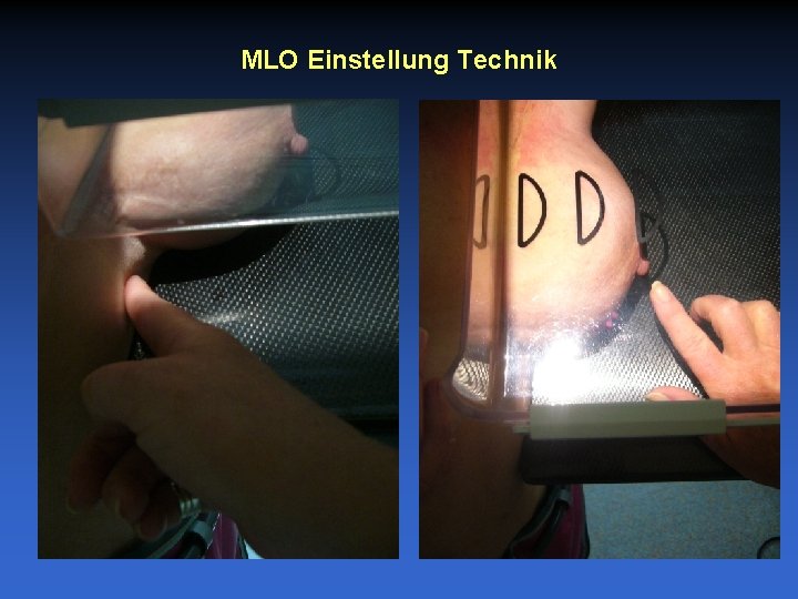 MLO Einstellung Technik 