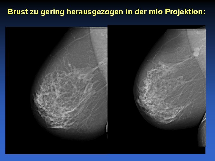 Brust zu gering herausgezogen in der mlo Projektion: 