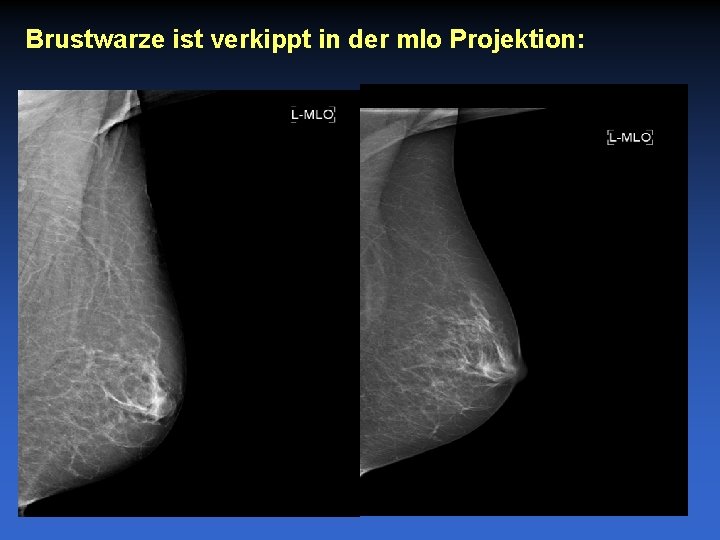 Brustwarze ist verkippt in der mlo Projektion: 