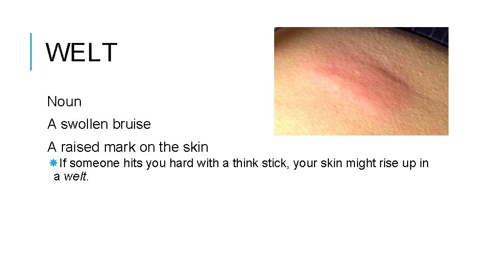 WELT Noun A swollen bruise A raised mark on the skin If someone hits
