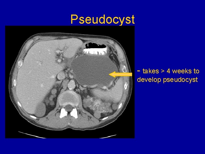 Pseudocyst - takes > 4 weeks to develop pseudocyst 