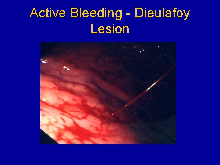 Active Bleeding - Dieulafoy Lesion 90% 