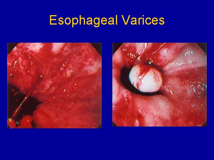 Esophageal Varices 