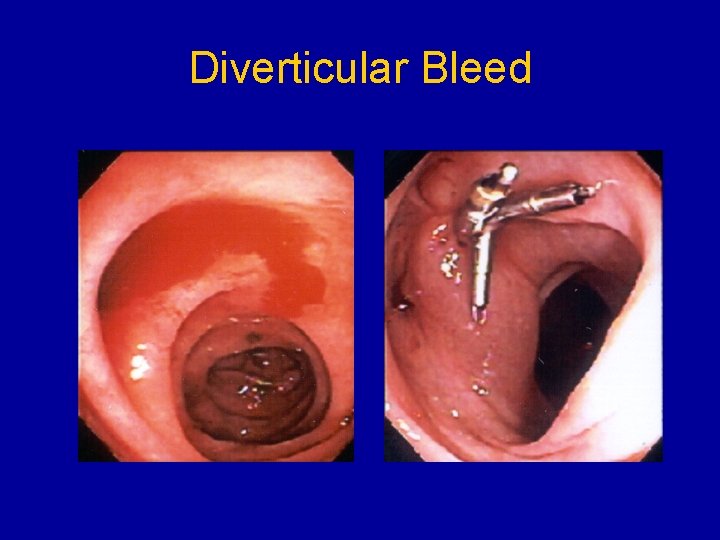 Diverticular Bleed 