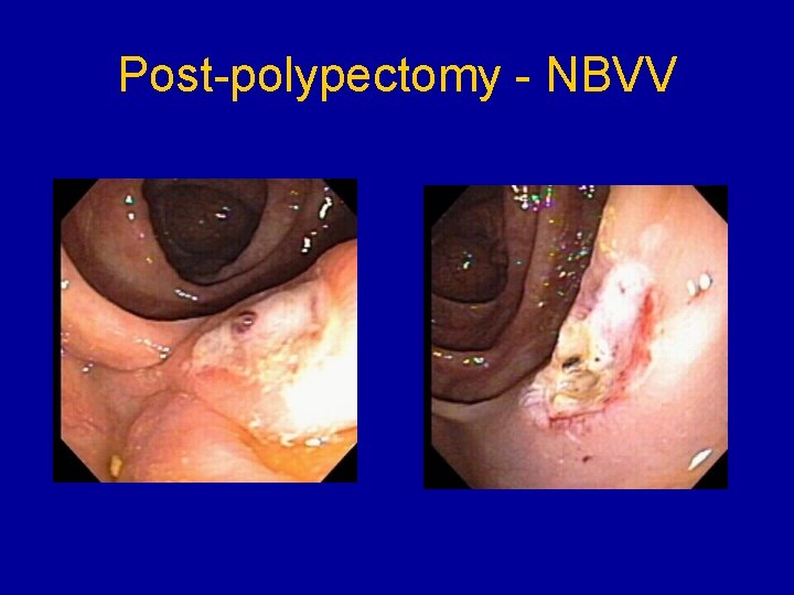 Post-polypectomy - NBVV 