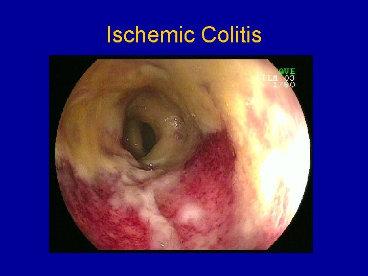 Ischemic Colitis 