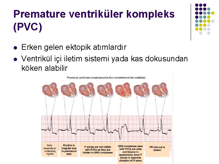Premature ventriküler kompleks (PVC) l l Erken gelen ektopik atımlardır Ventrikül içi iletim sistemi