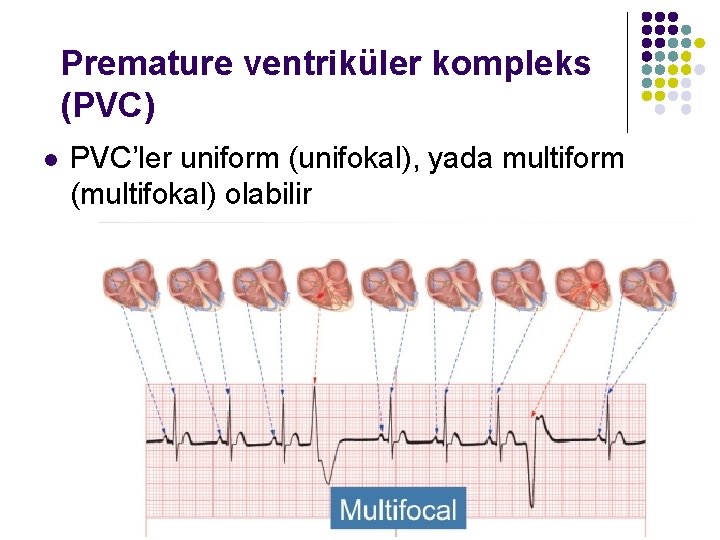 Premature ventriküler kompleks (PVC) l PVC’ler uniform (unifokal), yada multiform (multifokal) olabilir 