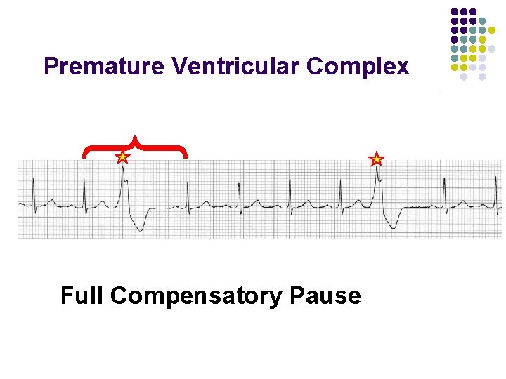Premature Ventricular Complex Full Compensatory Pause 