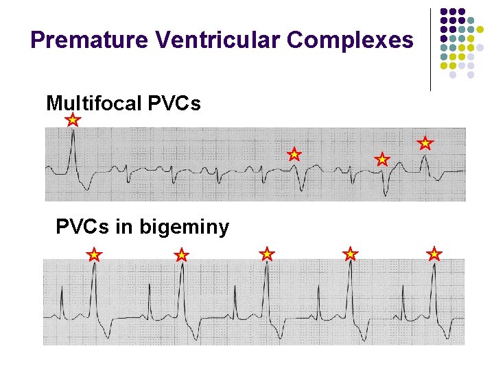 Premature Ventricular Complexes Multifocal PVCs in bigeminy 