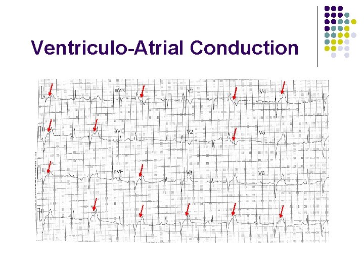 Ventriculo-Atrial Conduction 