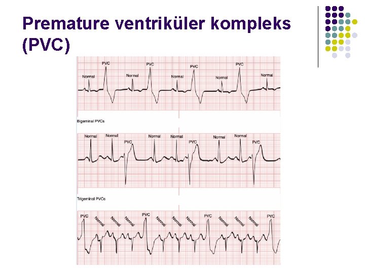 Premature ventriküler kompleks (PVC) 