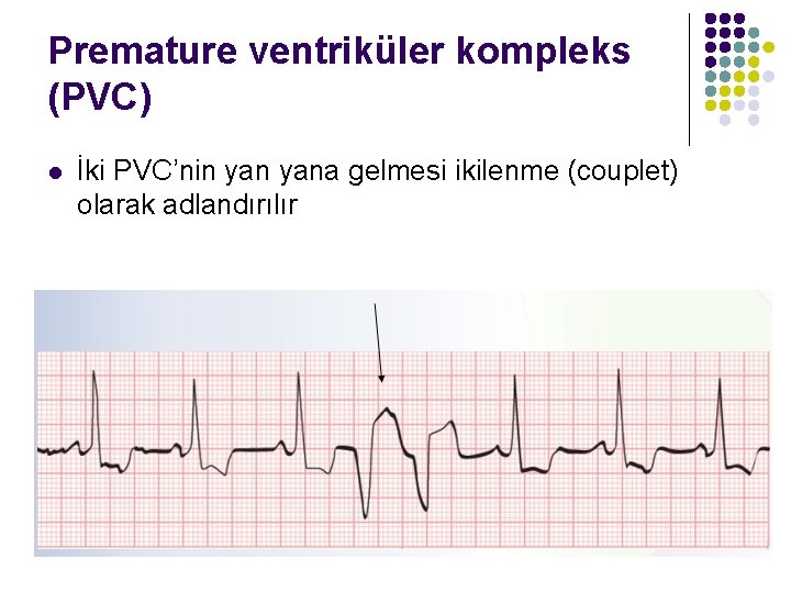 Premature ventriküler kompleks (PVC) l İki PVC’nin yana gelmesi ikilenme (couplet) olarak adlandırılır 