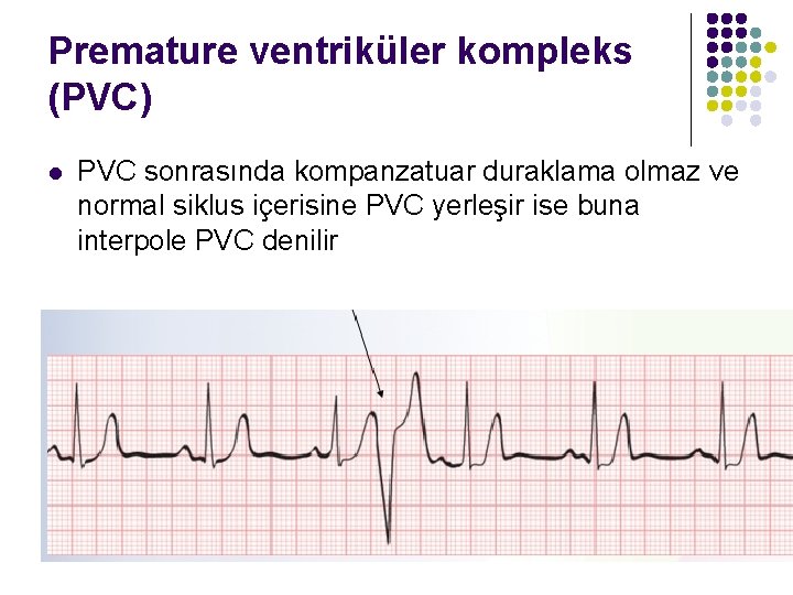 Premature ventriküler kompleks (PVC) l PVC sonrasında kompanzatuar duraklama olmaz ve normal siklus içerisine