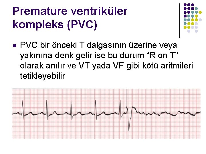 Premature ventriküler kompleks (PVC) l PVC bir önceki T dalgasının üzerine veya yakınına denk