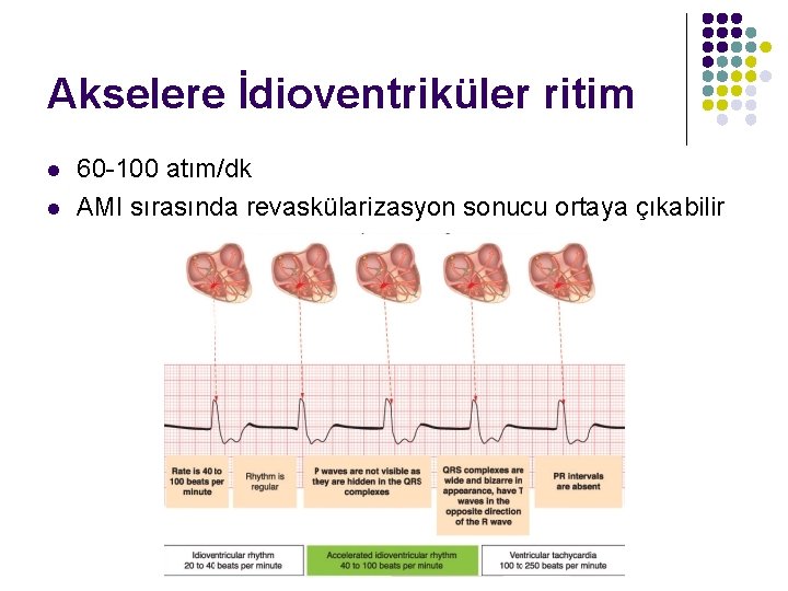 Akselere İdioventriküler ritim l l 60 -100 atım/dk AMI sırasında revaskülarizasyon sonucu ortaya çıkabilir