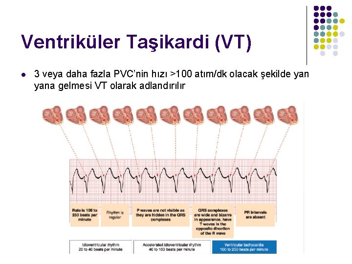 Ventriküler Taşikardi (VT) l 3 veya daha fazla PVC’nin hızı >100 atım/dk olacak şekilde