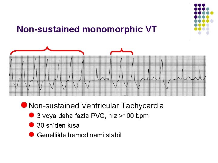 Non-sustained monomorphic VT l Non-sustained Ventricular Tachycardia l 3 veya daha fazla PVC, hız