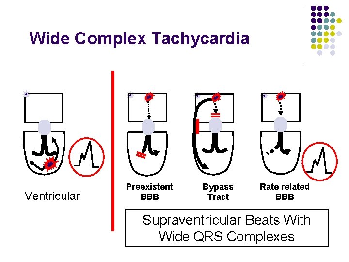 Wide Complex Tachycardia Ventricular Preexistent BBB Bypass Tract Rate related BBB Supraventricular Beats With
