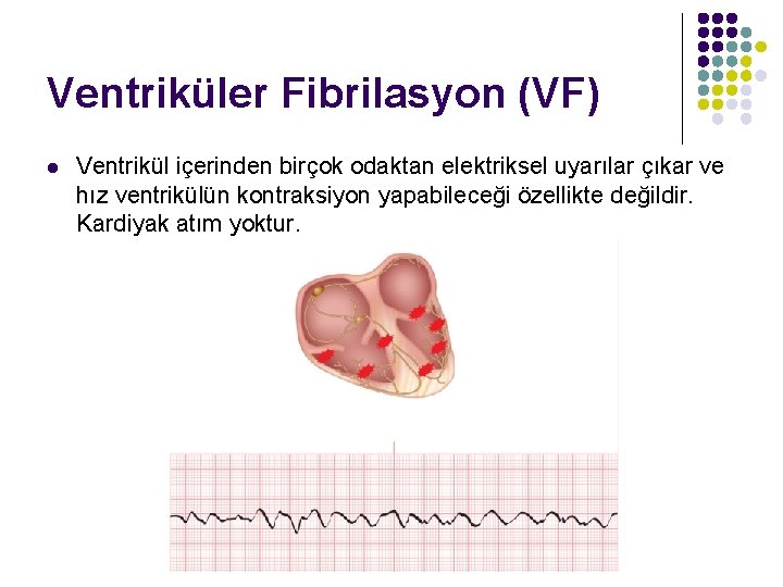 Ventriküler Fibrilasyon (VF) l Ventrikül içerinden birçok odaktan elektriksel uyarılar çıkar ve hız ventrikülün