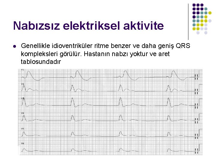 Nabızsız elektriksel aktivite l Genellikle idioventriküler ritme benzer ve daha geniş QRS kompleksleri görülür.