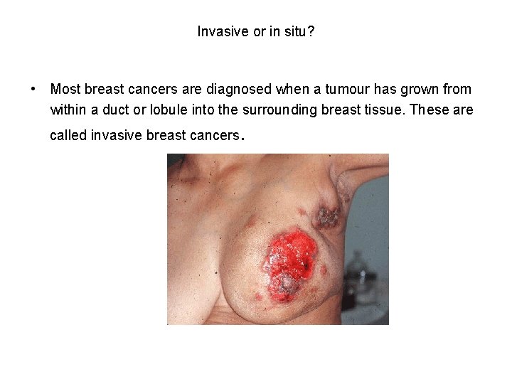 Invasive or in situ? • Most breast cancers are diagnosed when a tumour has
