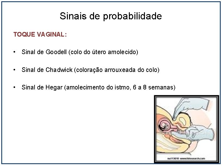 Sinais de probabilidade TOQUE VAGINAL: • Sinal de Goodell (colo do útero amolecido) •