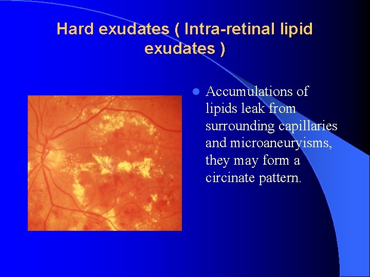 Hard exudates ( Intra-retinal lipid exudates ) l Accumulations of lipids leak from surrounding