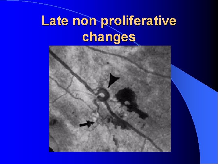 Late non proliferative changes 