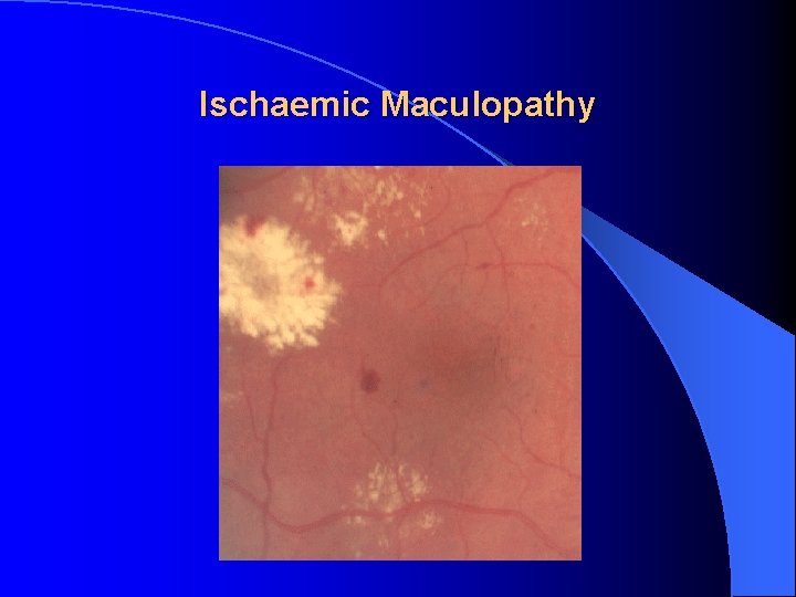 Ischaemic Maculopathy 