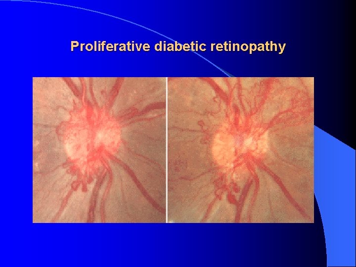 Proliferative diabetic retinopathy 