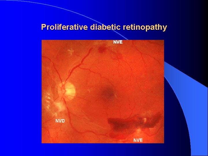 Proliferative diabetic retinopathy 