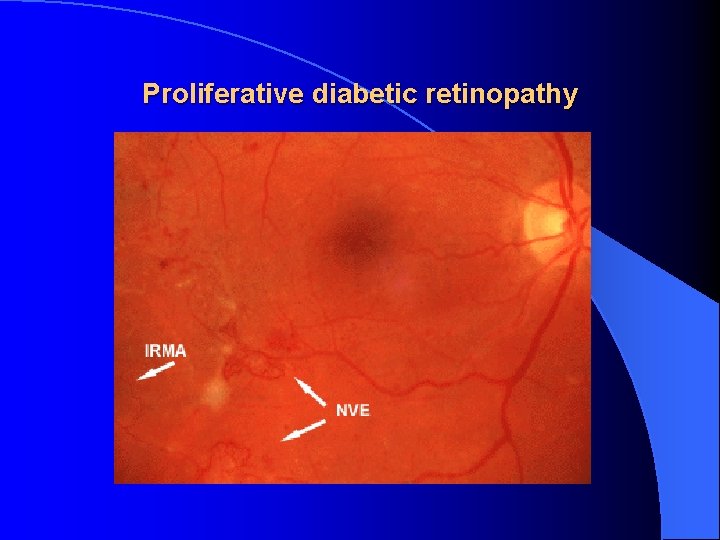 Proliferative diabetic retinopathy 