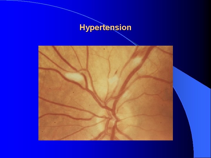 Hypertension 