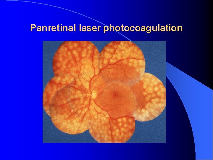 Panretinal laser photocoagulation 